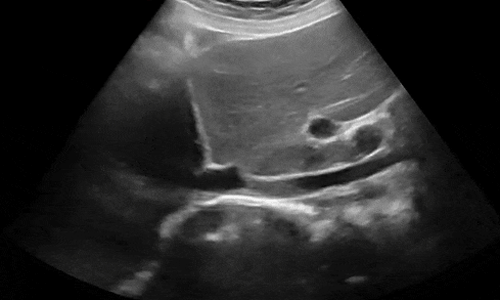 Anwendungsbeispiel Clarius C3 HD abdominal liver IVC
